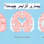 بیماری آلزایمر چیست؟