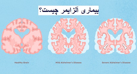 بیماری آلزایمر چیست؟