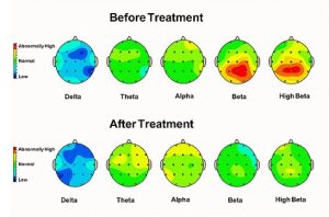 روش‌های بررسی امواج مغزی در اوتیسم